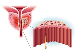différence adénome prostatite