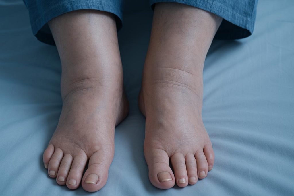 Que faire en cas de pieds et chevilles gonflés en fin de journée à cause d'un problème de circulation